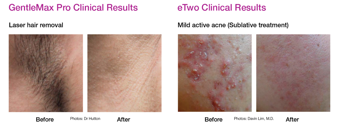 Gentle_eTwo_clinical-results.png