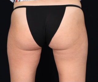 Cellulite_After.jpg