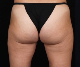 Cellulite_Before